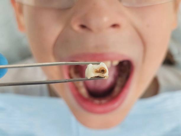 Best Emergency Root Canal Treatment in Coweta, OK
